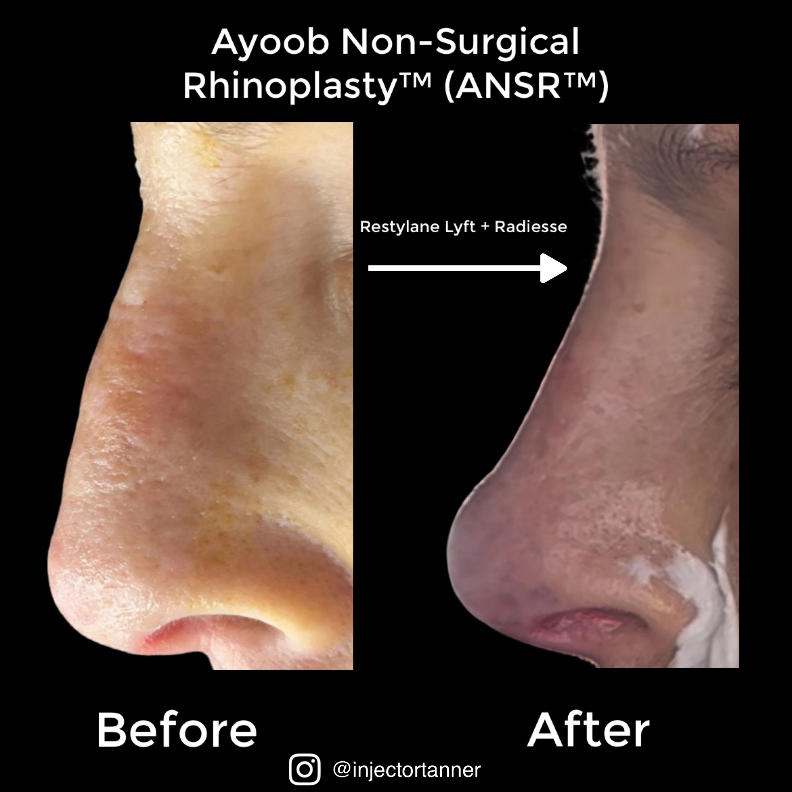 Before and after non-surgical rhinoplasty using Restylane Lyft and Radiesse.