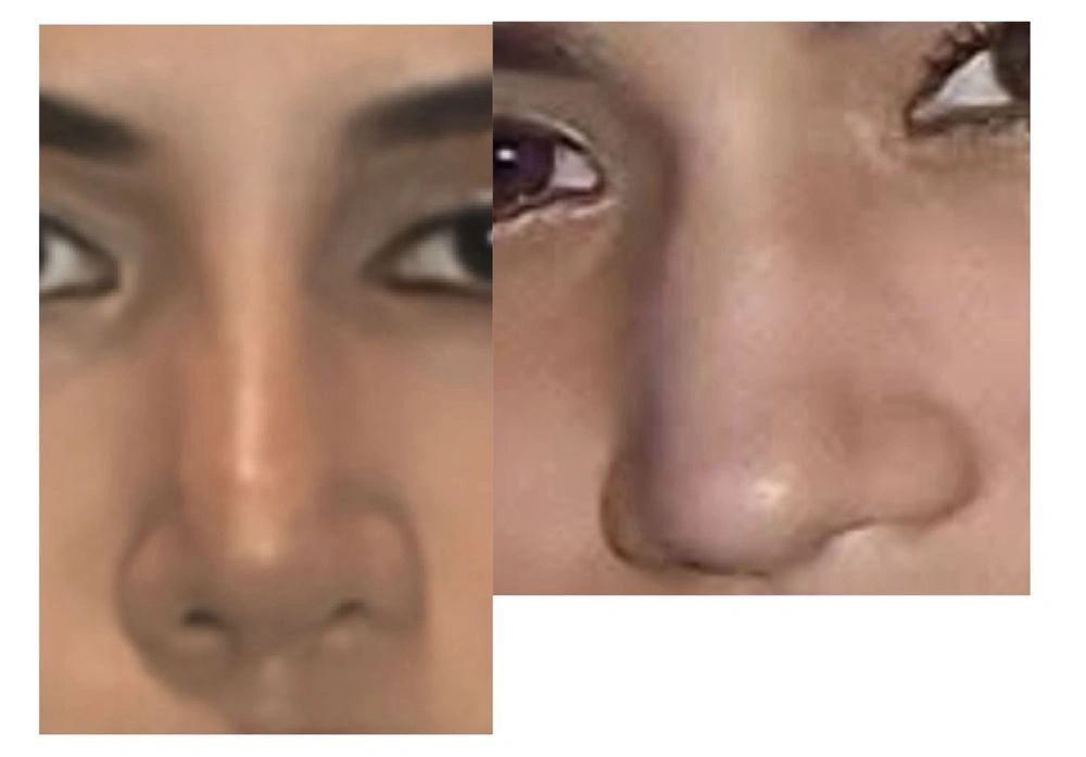 Patients own photos via yelp of her Juvederm Voluma and JUvederm Vollure Non-Surgical Rhinoplasty