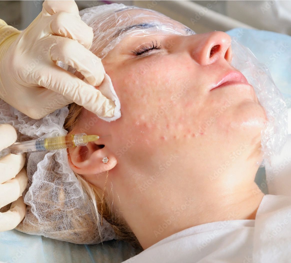 Close-up of a woman receiving a facial injection for acne treatment.