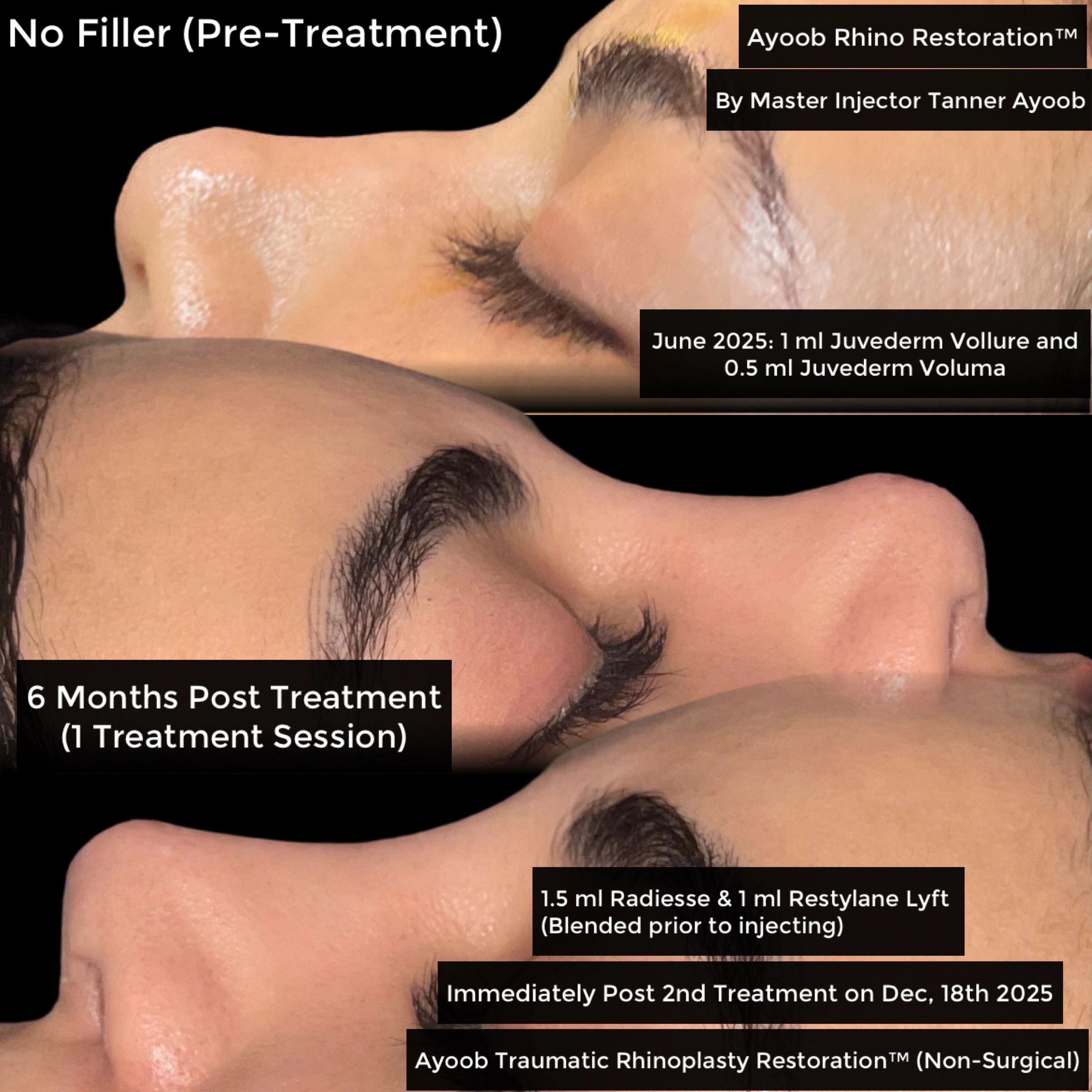 Side-by-side comparison of a nose pre-treatment and post 6 months treatment. Retouched at 6 month mark.