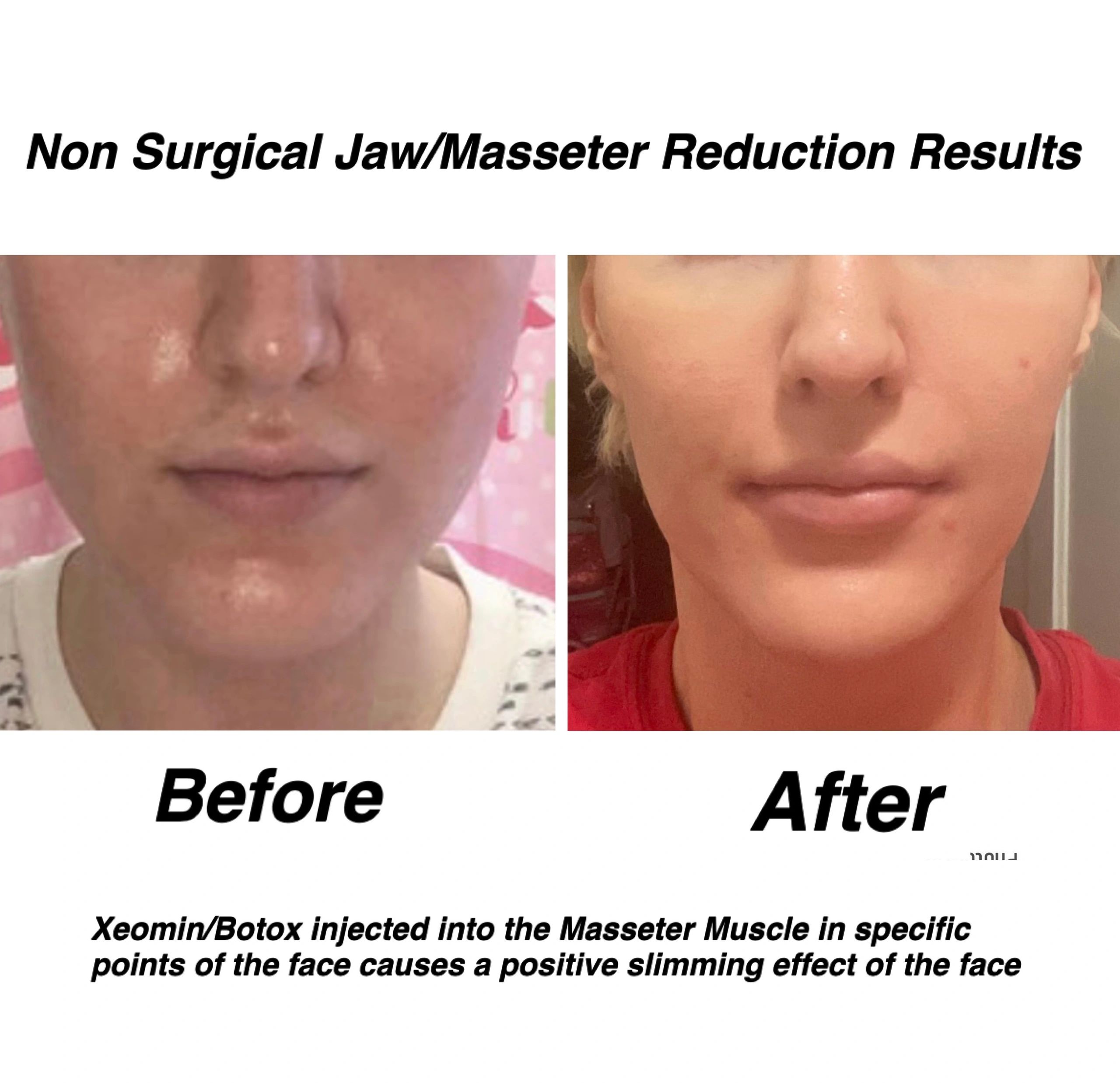 2 sessions ND:YAG laser to underyes for dark circle discoloration, masseter botox, and chin filler. Patient had gotten chin filler and Botox to masseter for the past 7 years but had to take a break due to financial constraints and lower face continued to expand as in the photo and got larger and larger until we treated it again with 120 iu to masseter and Juvederm Voluma to chin.