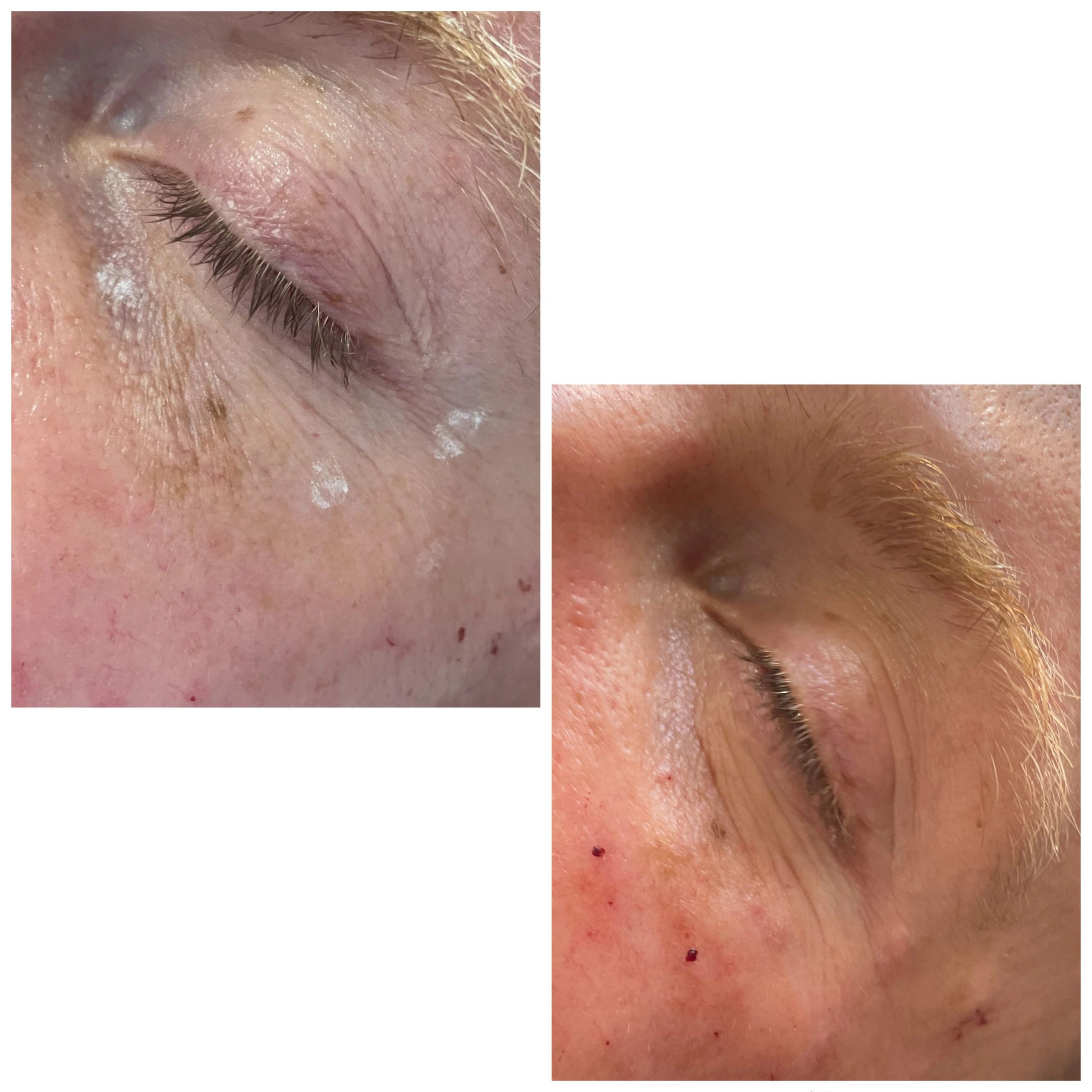 40 units Xeomin, 1 ml Restylane Defyne and 1 ml Restylane Classic.