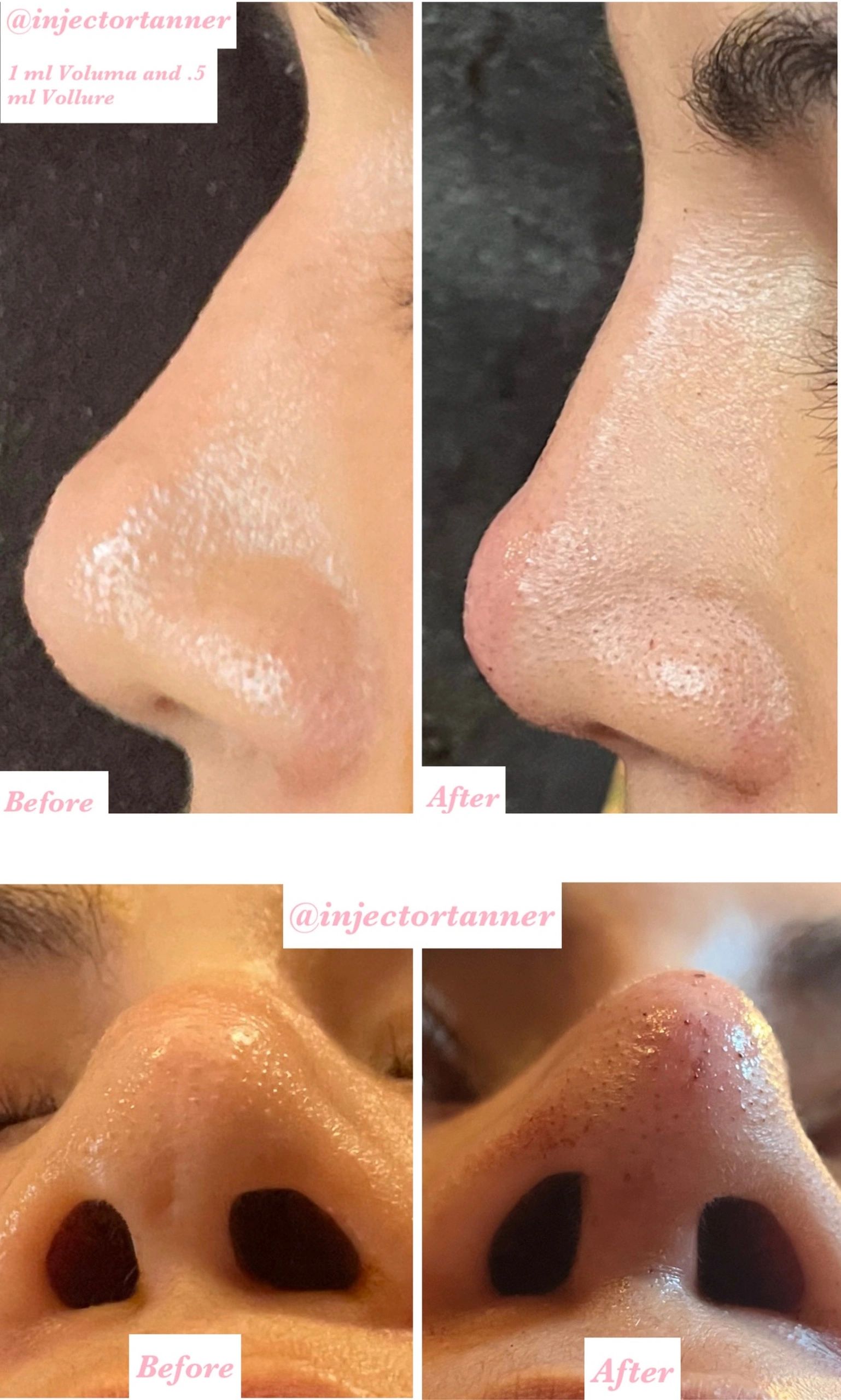 1 ml of Juvederm Voluma and 0.5 ml of Juvederm Vollure Non Surgical Rhinoplasty