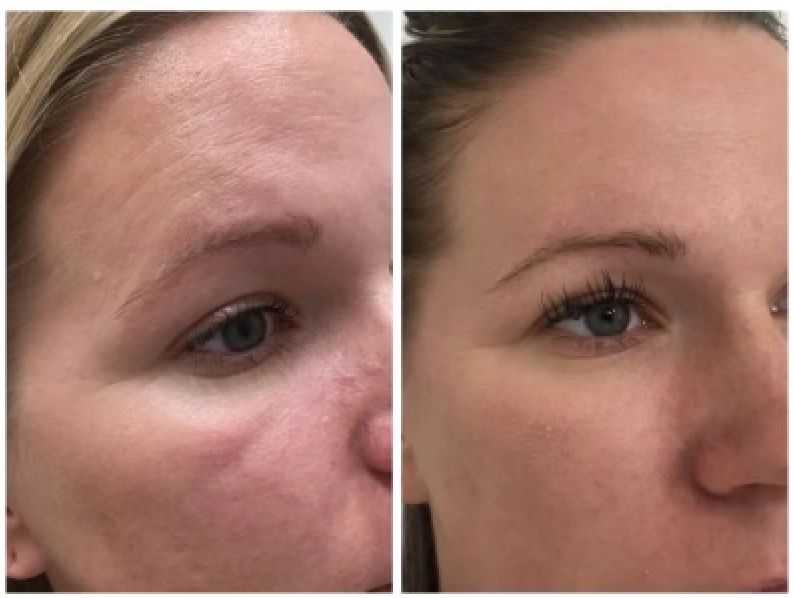 Tox (Dysport), Restylane-L and Restylane Refyne