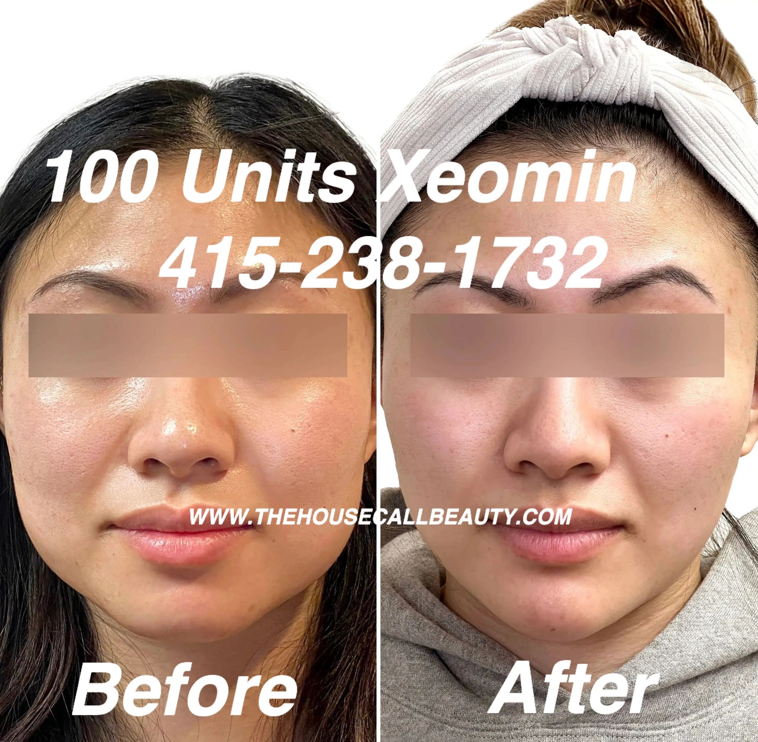 100 units of Xeomin Special Offer for $800 Jaw Slimming Offer Masseter Reduction Botox