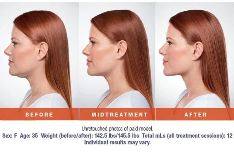 Kybella images provided by Allergan Aesthetics, to showcase the results of submental treatment