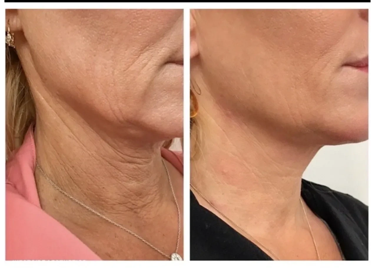 Radiesse® Neck Lift WITH INJECTOR TANNER AYOOB