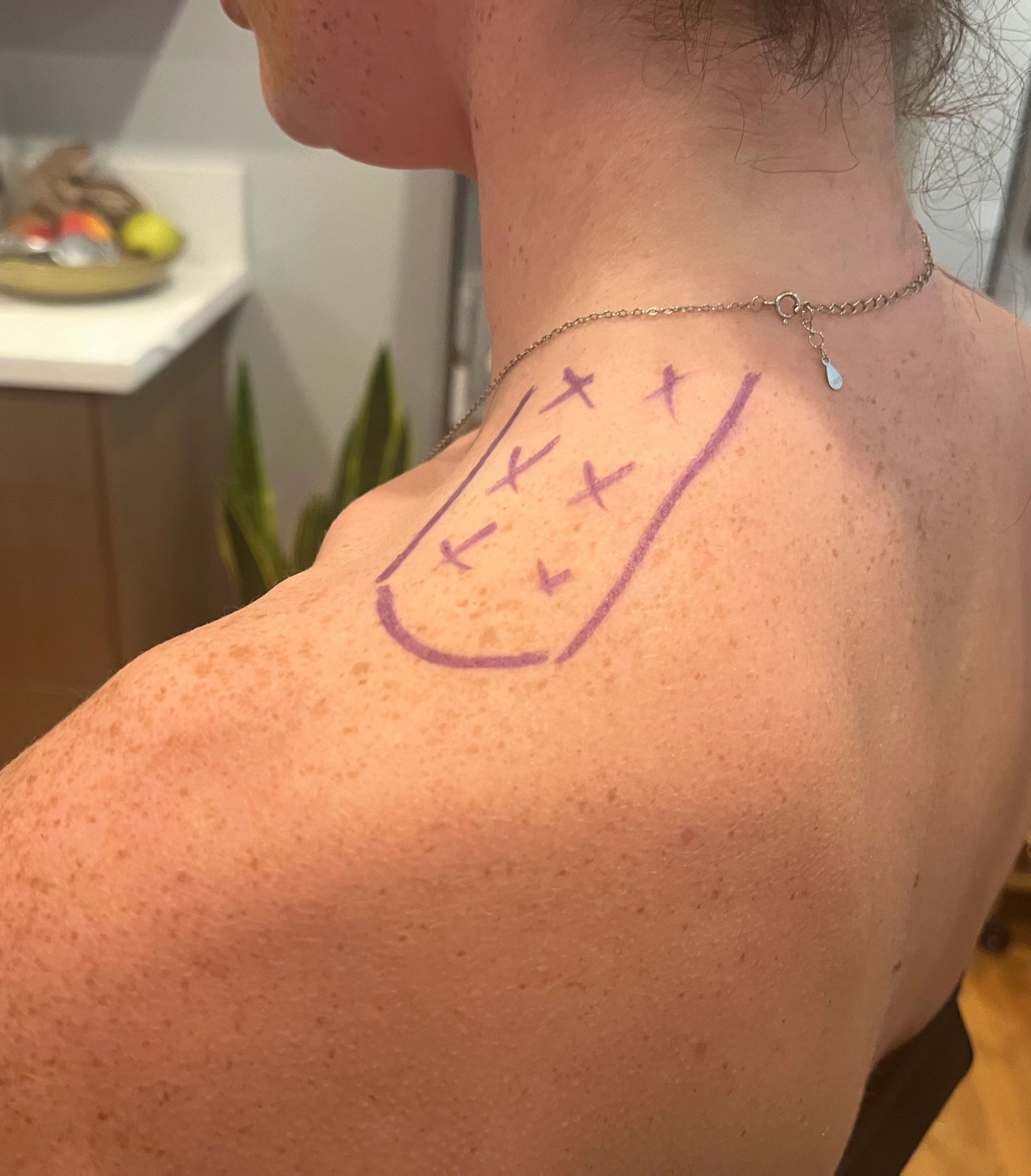 Purple marker outlines and crosses on a person's shoulder and upper back.