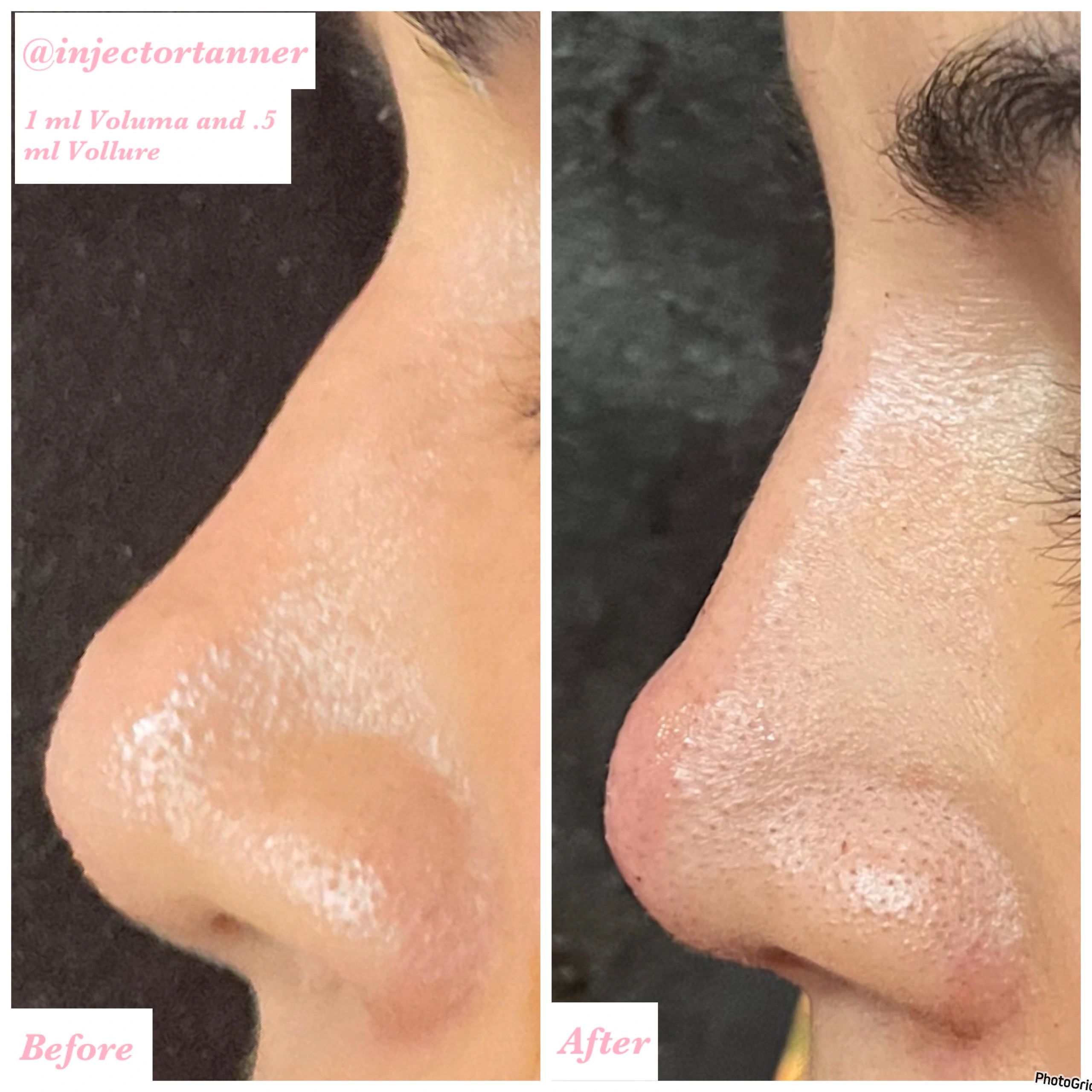 Radix and Nasal Tip Augmentation using Voluma and Vollure