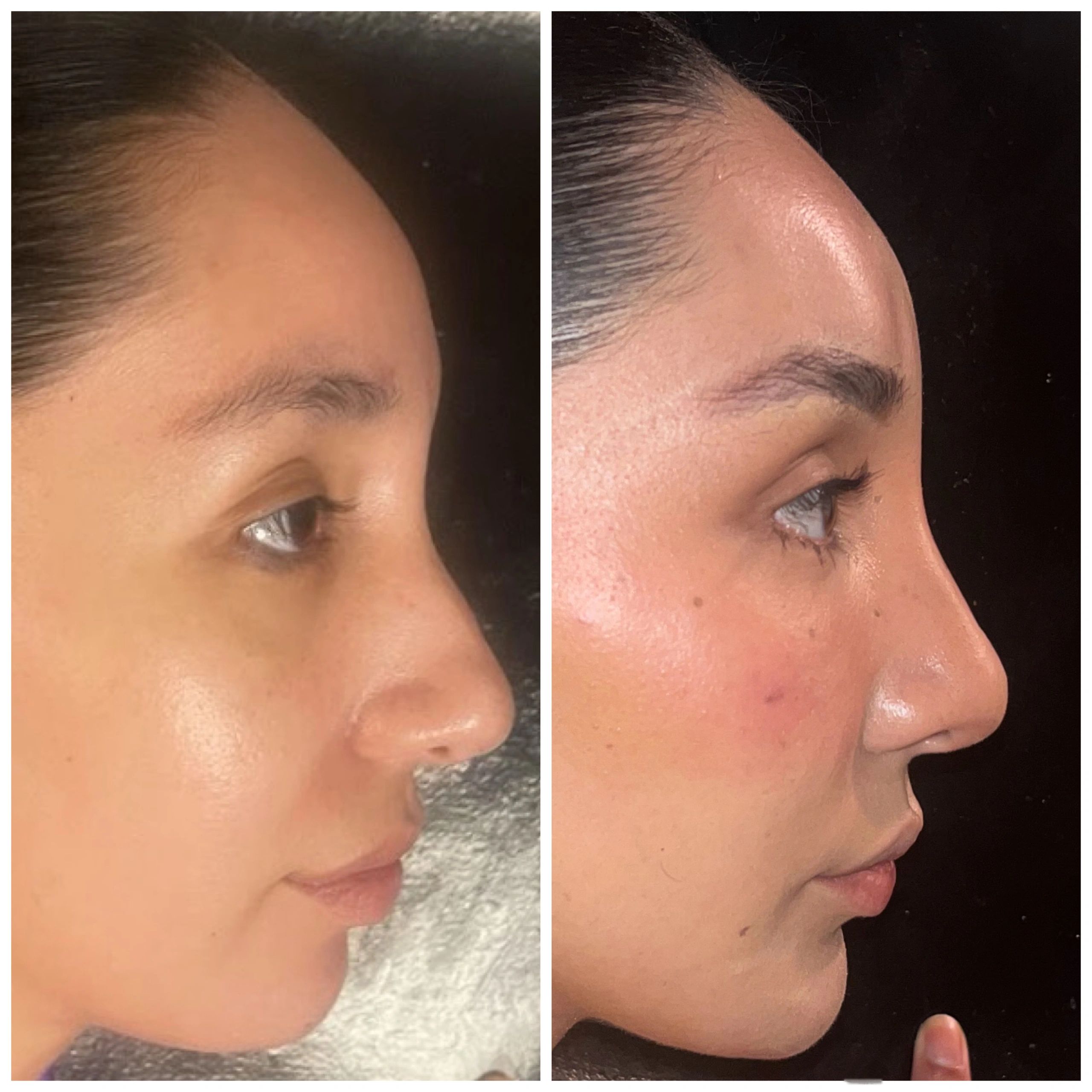 Chin, Forehead, MId-Face. Nose and Nasolabial Fold Treatmeant with Radiesse, Vollure & Voluma Filler