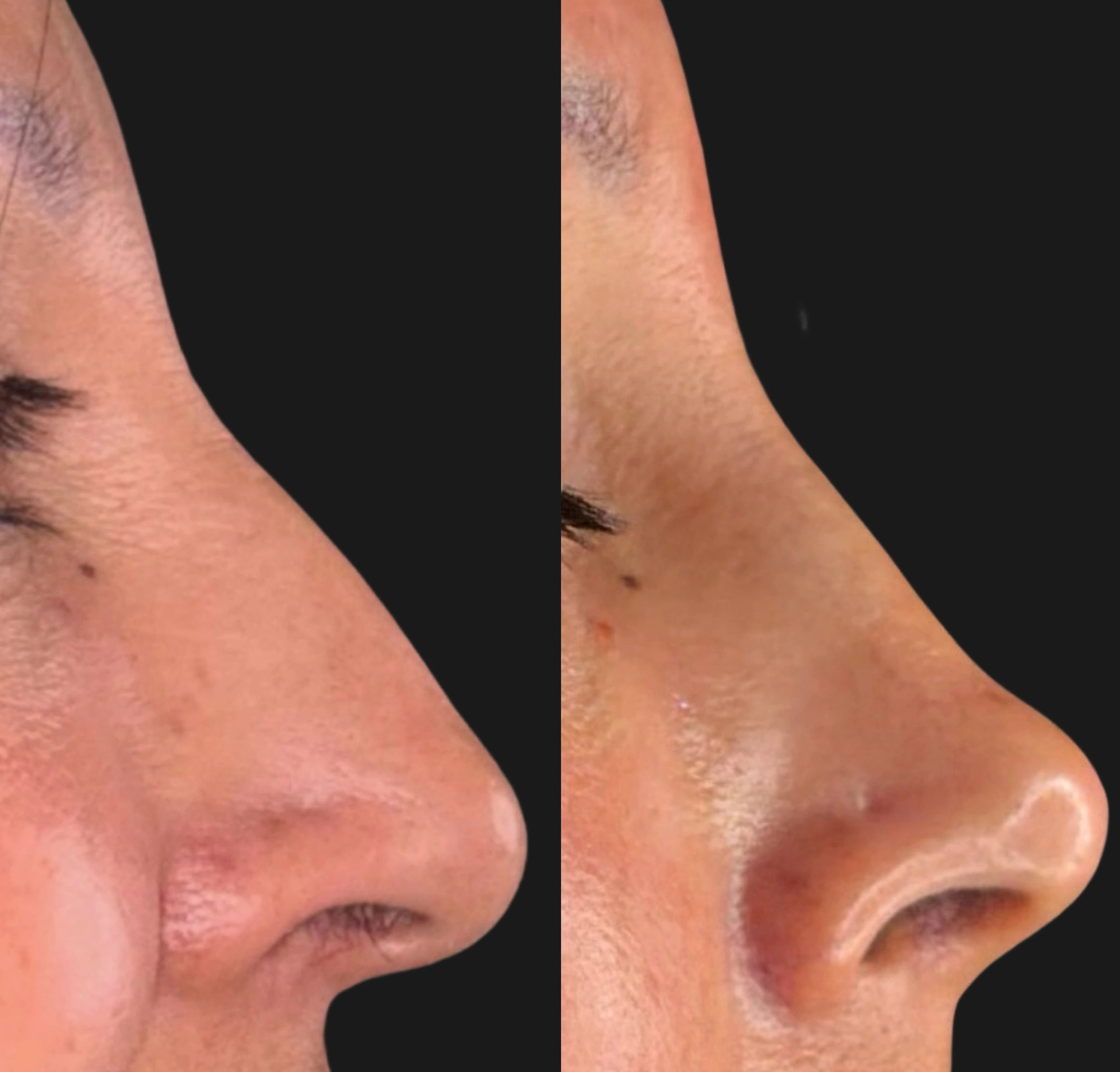 before and after non-surgical rhinoplasty using filler to refine nasal bridge & tip in San Francisco