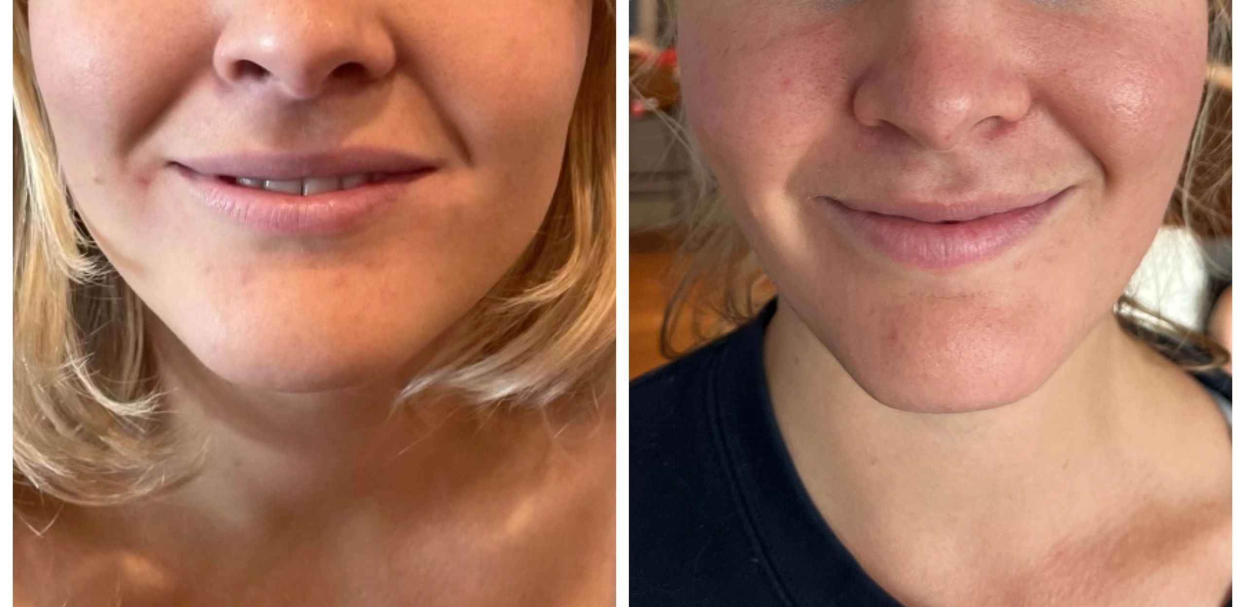 Masseter Reduction with 100 IU Xeomin