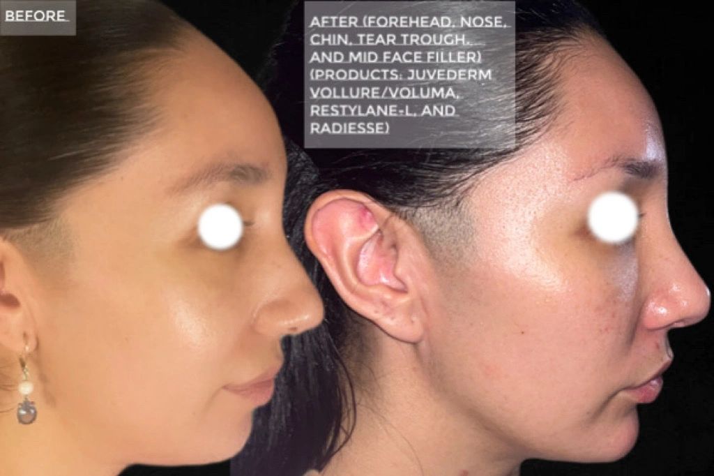 Forehead, Chin, Nose, Midface/Tear Through and Nasolabial Fold Filler w/ Voluma, Vollure & Radiesse