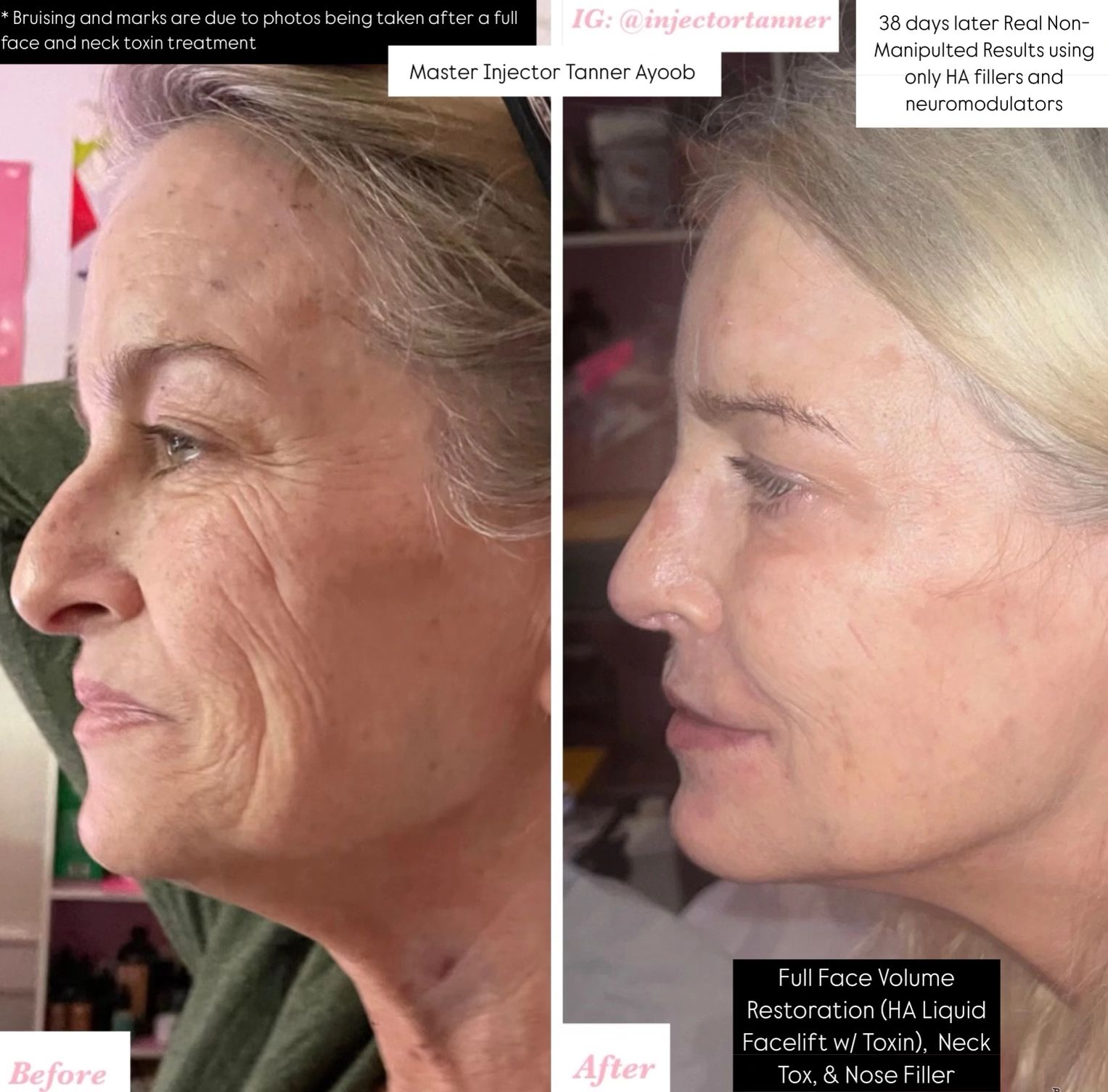 Non-Surgical Facelift with Non-Surgical Rhinoplasty using Injectables: Juvederm & Botox