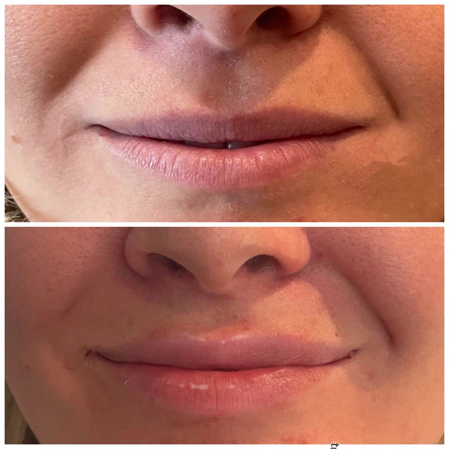 RHA 3 Lip Filler