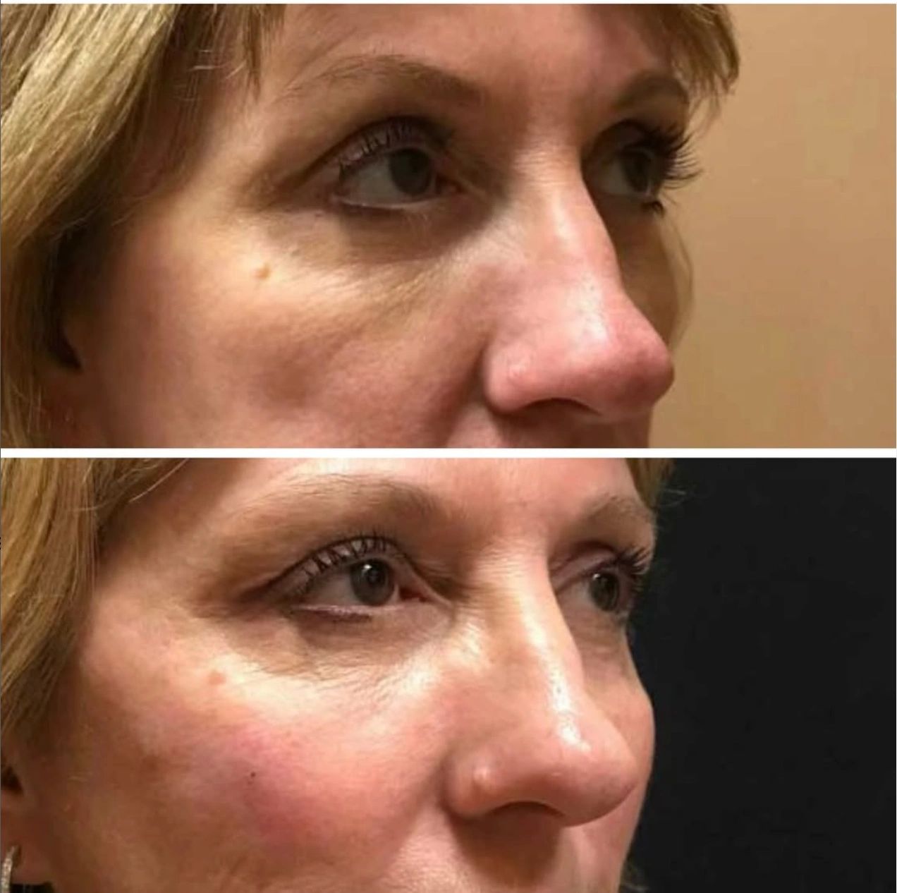 Juvederm Voluma