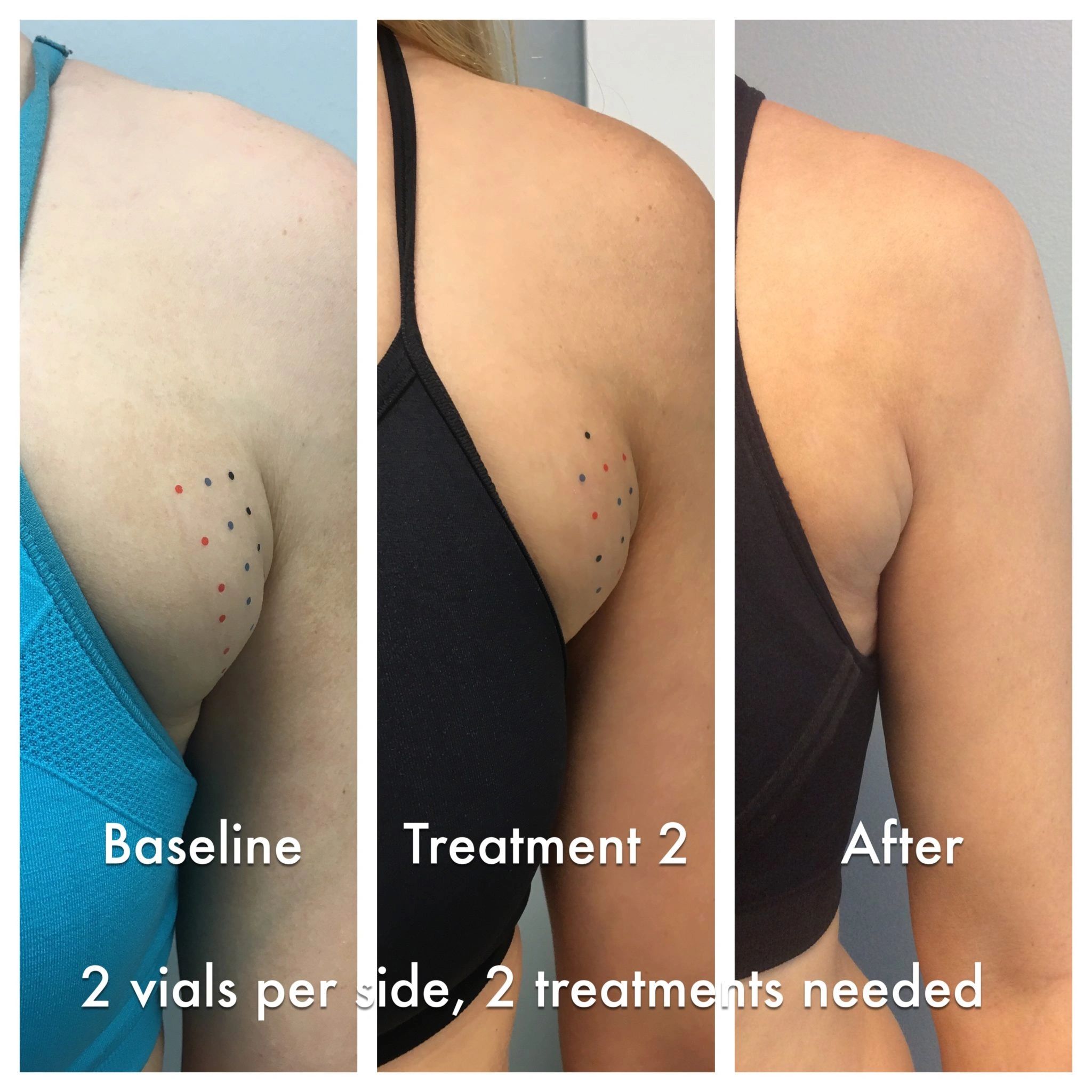 Underarm “Armpit Fat” or Bra Fat size progression over three stages with treatments of Kybella