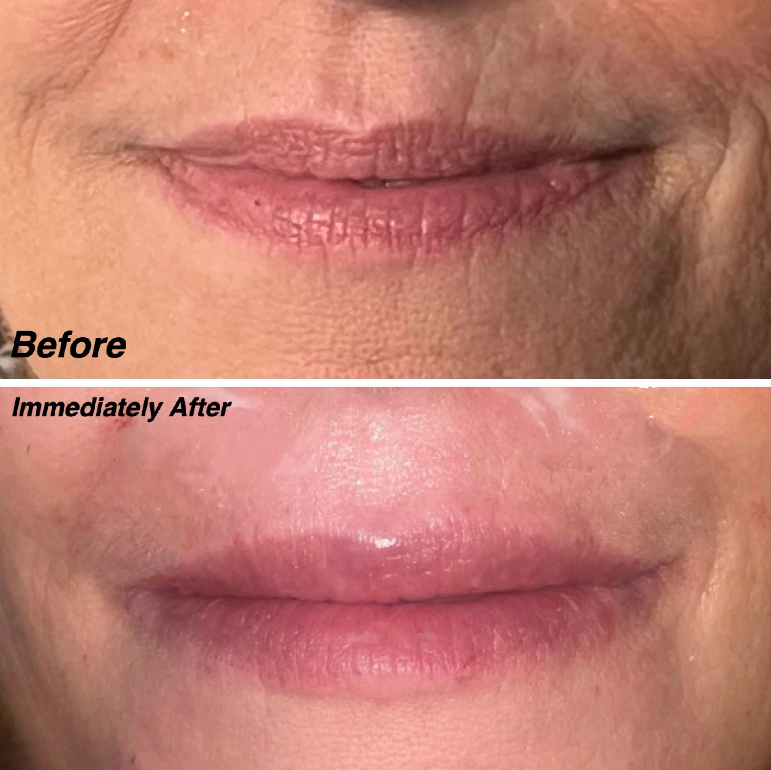 1 syringe of Restylane-L to the lips (the pink of the lips) for lip augmentation and 2 syringes of Restylane Silk (injected into the “Upper and Lower Lip Lines “Smoker Lines”“, Silk was not injected into the pink portion or body of the lips but in the non-pink/)