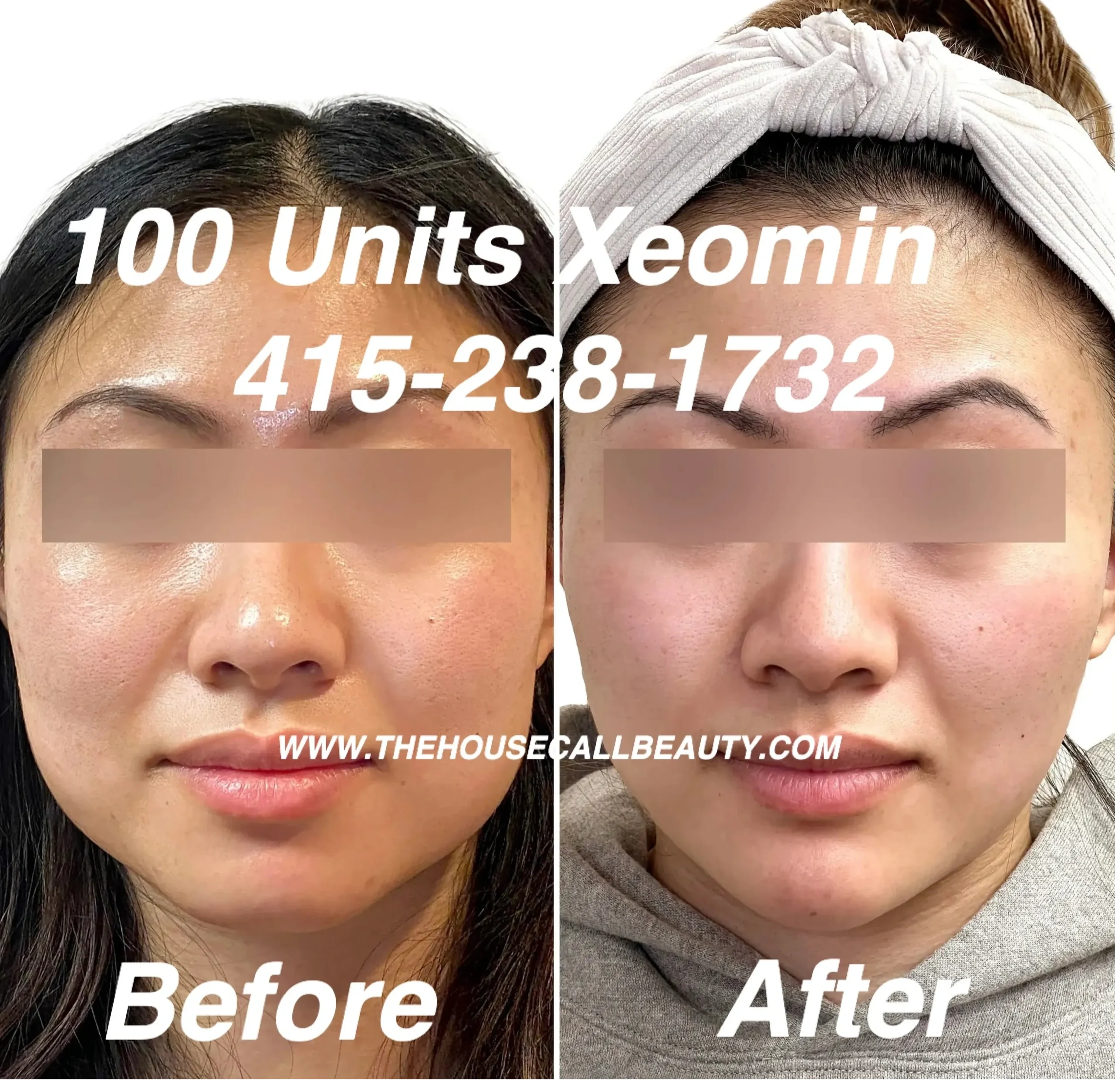 Before and after Botox treatment on masseter and chin filler.