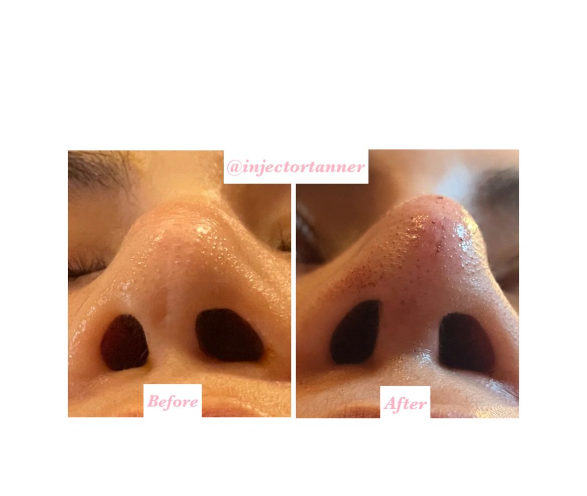 Non Surgical Rhinoplasty Using Juvederm Voluma and Vollure. Collumela and Nasal Tip Augmentation