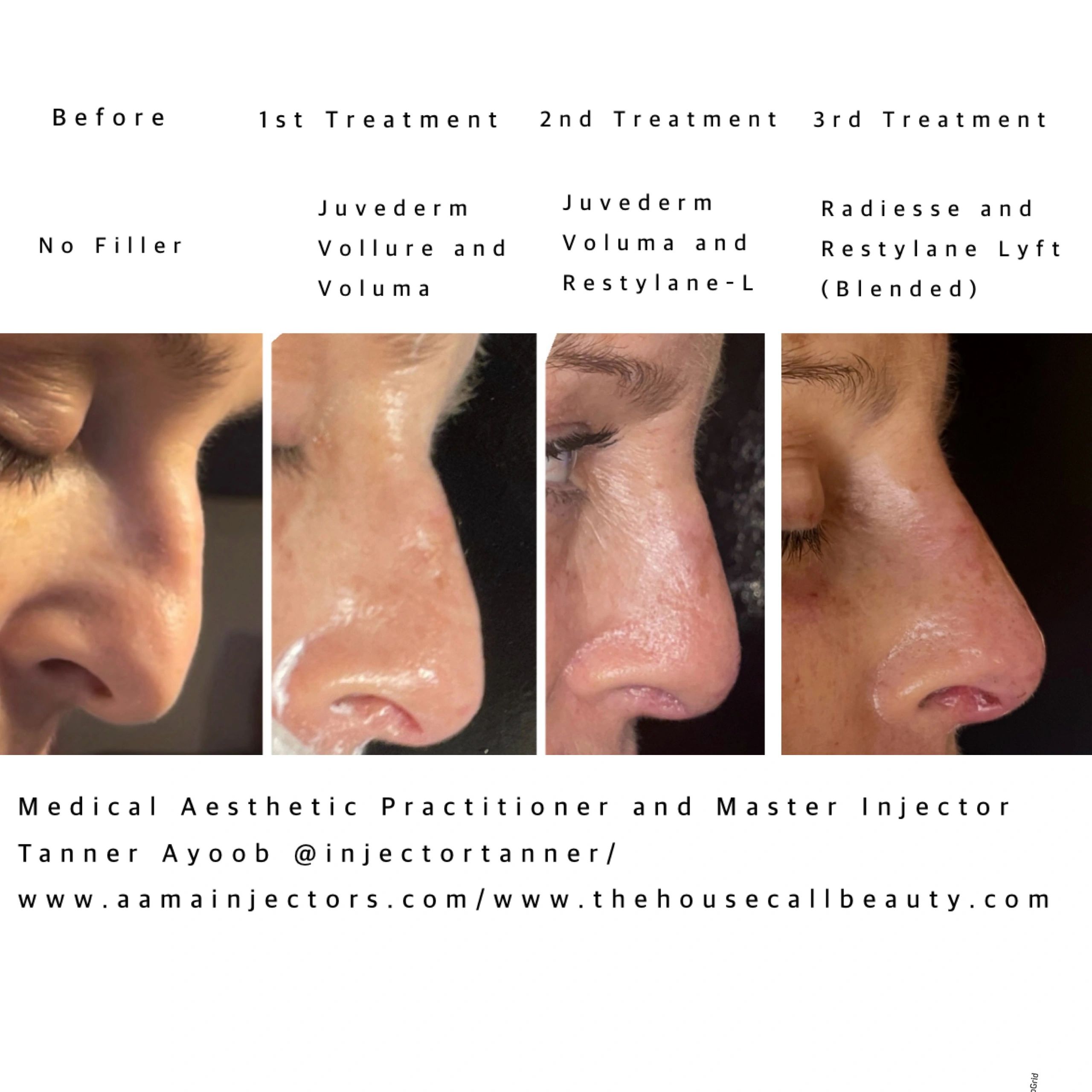 Multi-Phase Non-Surgical Rhinoplasty by Master Injector & Founder Tanner Ayoob